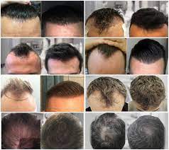 تكلفة زراعة الشعر في تركيا بالريال السعودي